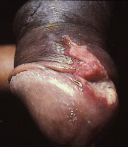 Lymphogranuloma on head of penis