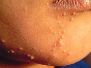 Molluscum contagiosum outbreak on face