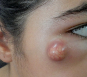 Molluscum contagiosum on young girl