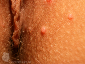 Molluscum contagiosum on vagina