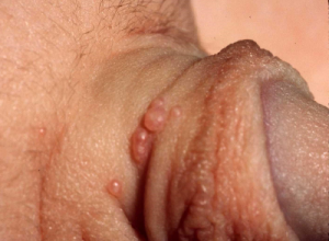 Molluscum contagiosum bumps on penile region