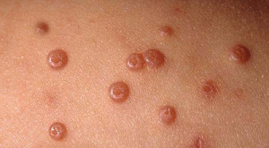 Bumps caused from Molluscum 