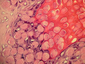 Molluscum Pictures 14 - Herpes & Coldsores Support Network Microscopic view of Molluscum