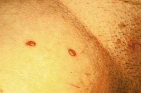 Molluscum contagiosum outbreak on female genitals