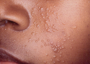 Facial Molluscum contagiosum