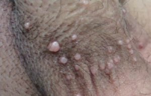 Molluscum contagiosum symptoms on penis