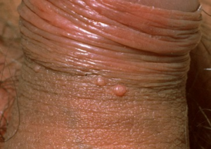 Male genital Molluscum contagiosum bumps