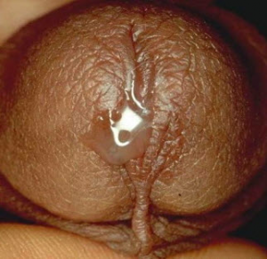 Trichomoniasis discharge from male penis