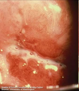 Female Trichomoniasis condition