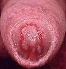 Male penis infected with Trichomoniasis