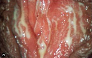 Female genitals with Trichomoniasis