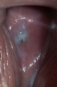 Discharge symptom caused form Trichomoniasis