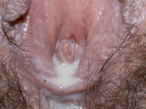 White female with Trichomoniasis