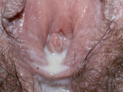 Genital Warts - Home Remedies, Causes, Symptoms, Treatment ...