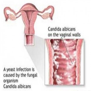 Yeast infection pictures
