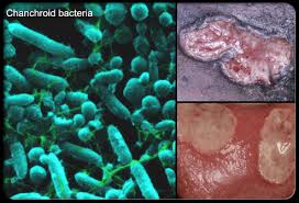 chancroid bacteria