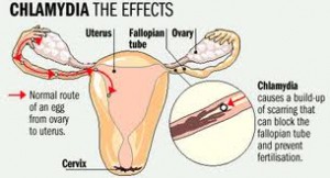 chlamydiaeffectswomen