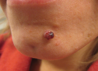 Symptom of granuloma on chin