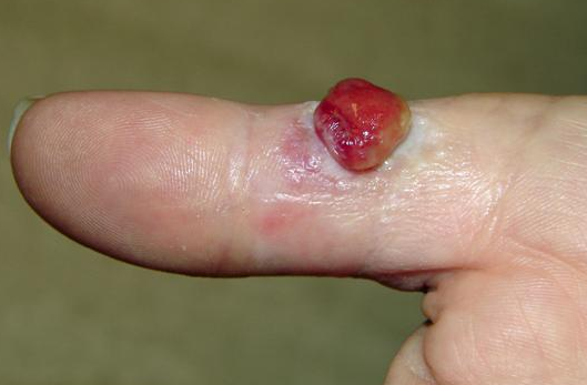 Pyogenic Granuloma. Free Professional Reference | Patient