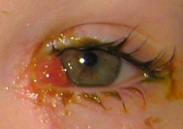 Granuloma of the eye