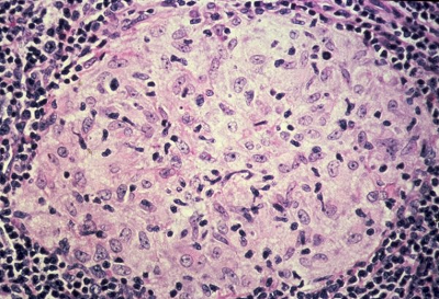 Granuloma cells