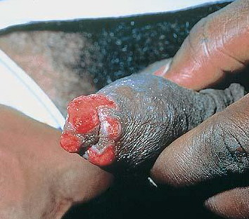 Male Genital Granuloma 