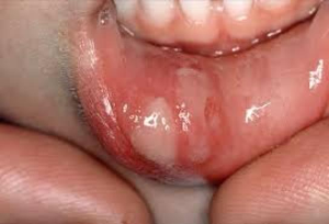 Herpes ulcer inside lip