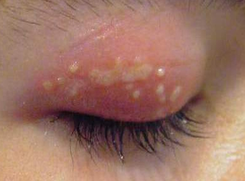 Herpes SImplex in the Eye
