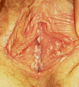 HSV 2 in vagina