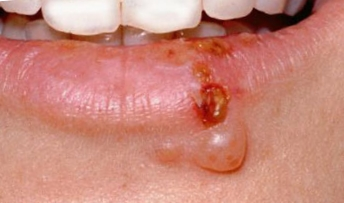 Herpes SImplex on the lip