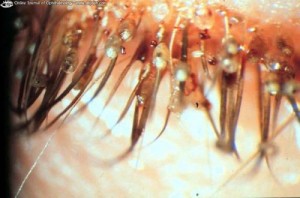 Pubic lice usually attach to hairs on the groin,  but can also attach to the eyebrows and other hairs