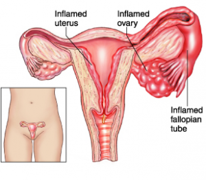 Pelvic Inflammatory Disease (PID) Pictures 4 - Herpes & Coldsores Support Network Chart of Woman anatomy related to PID