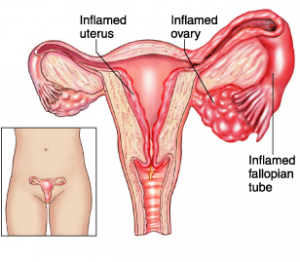 Chart of Woman anatomy related to PID