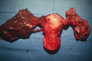 Pelvic Inflammation Disease in female uterus