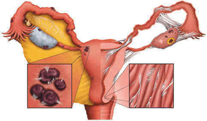 Results of Pelvic Inflammation Disease in the female reproductive organs