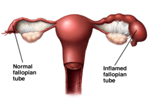 Healthy vs Pelvic Inflammation Disease tubes