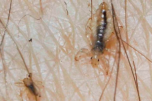 Live Pubic Lice in genital hairs
