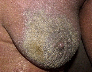 Crusted Scabies condition