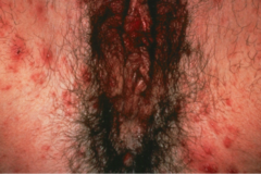 Female Scabies infection