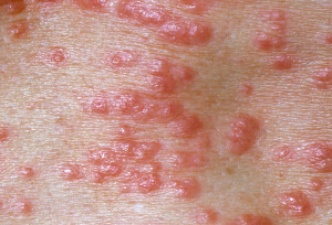 Symptom of Scabies