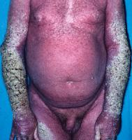 Male Scabies on torso