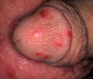 Penis with Scabies