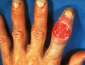Finger developed a ulcer from syphilis