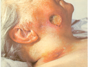 Chronic syphilis infection