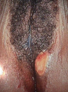 syphilis ulcer on womans vagina