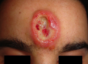 Ulcer developed after chronic syphilis infection