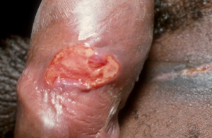 Male genitals with syphilis ulcer