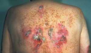 Rash fromsyphilis on back