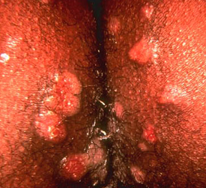 Vagina with syphilis