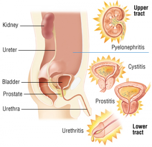 UTI/Cystitis in men